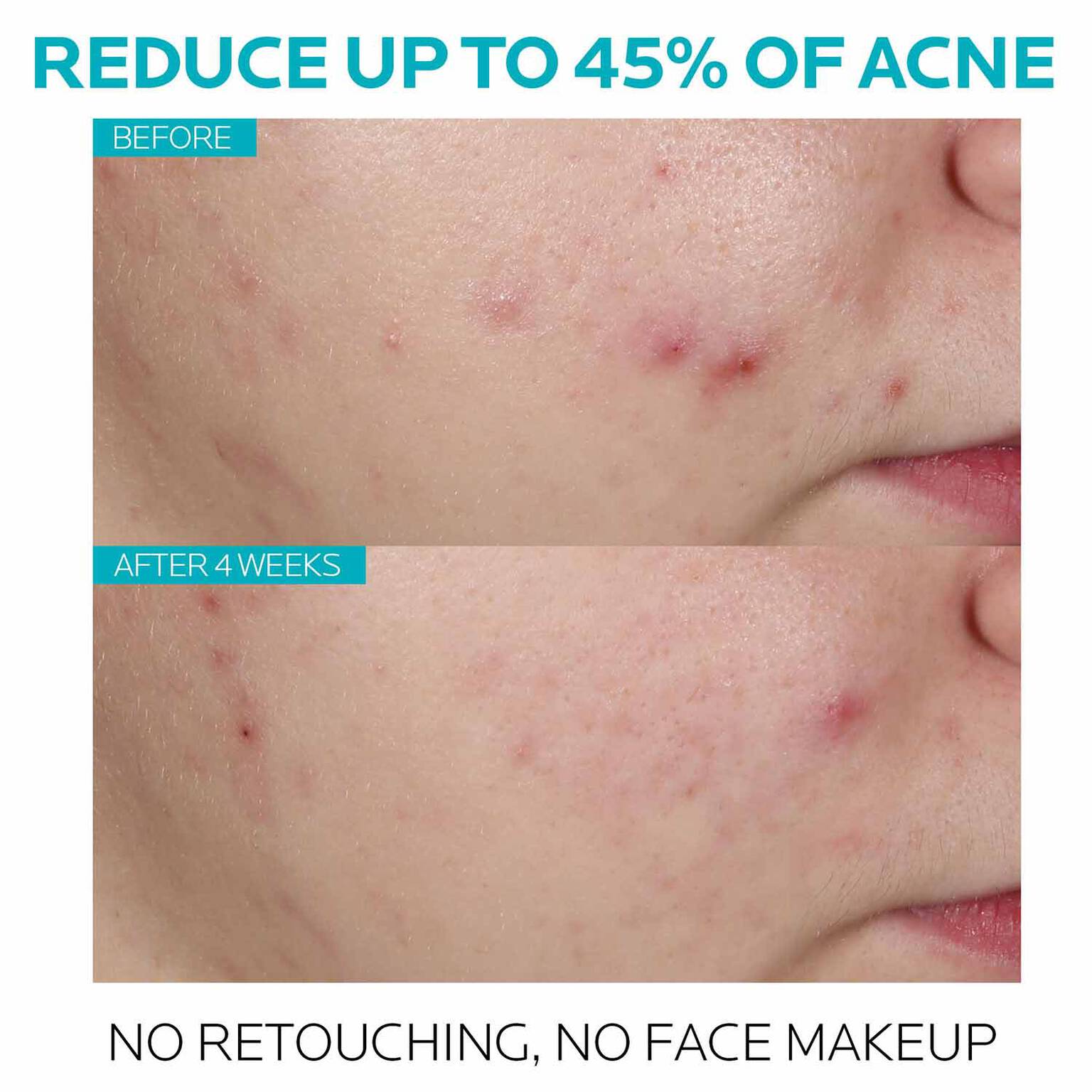 effaclar-salicylic-acid-acne-treatment-serum-m8 7_EffaclarSerum_After-45-days.jpg