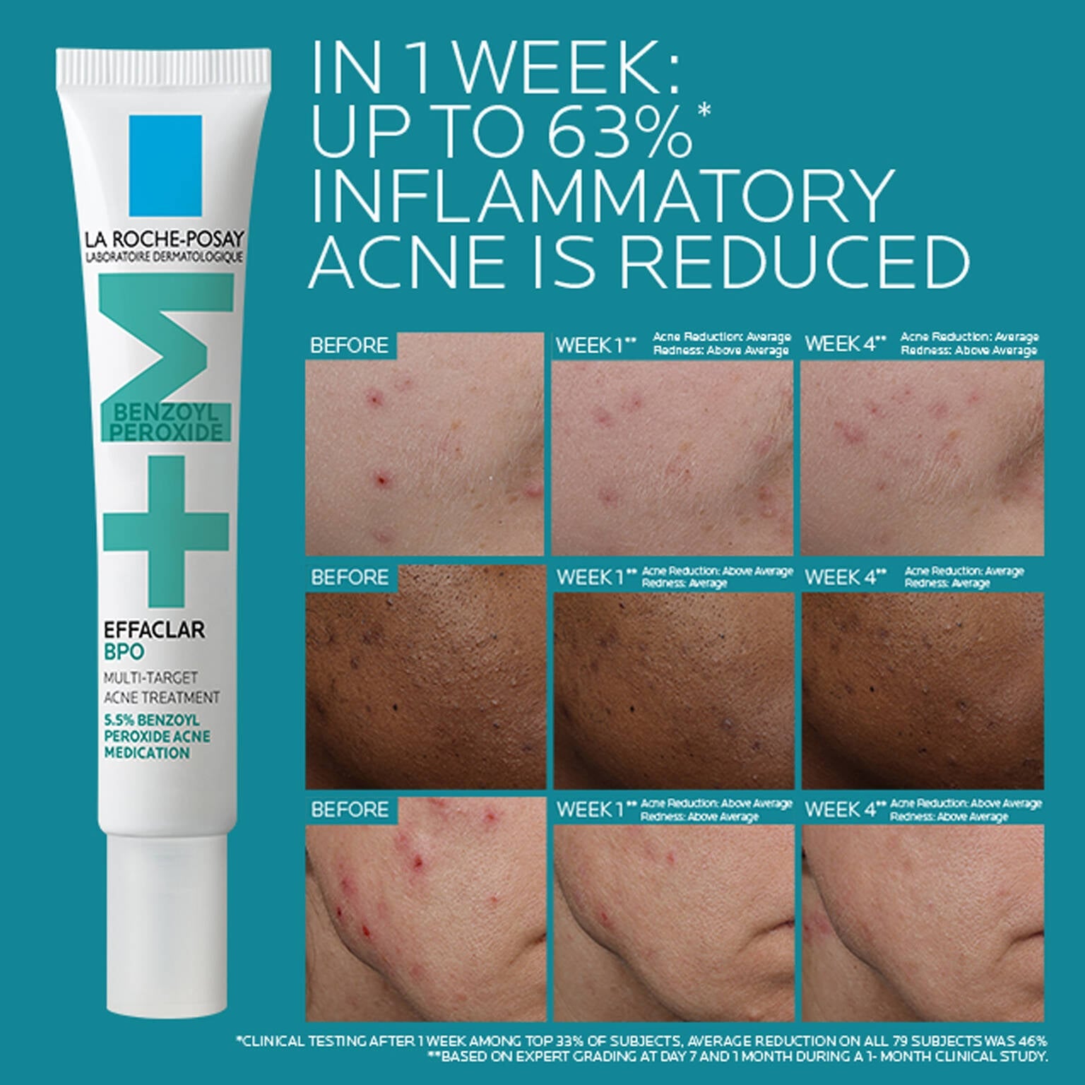 effaclar-bpo-multi-target-acne-treatment-with-5-5-benzoyl-peroxide-j9 EffaclarBPO-ClinicalBA-ATF-1500x1500-2.jpg