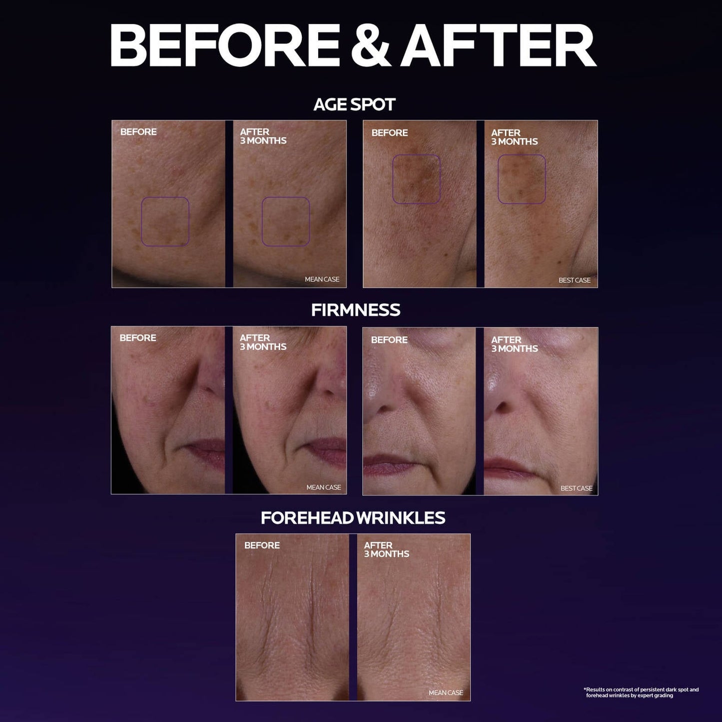 mela-b3-double-dose-discoloration-treatment-with-melasyltm-x2 MelaB3_DD_BTF_BeforeAfter_1500x1500_5.jpg