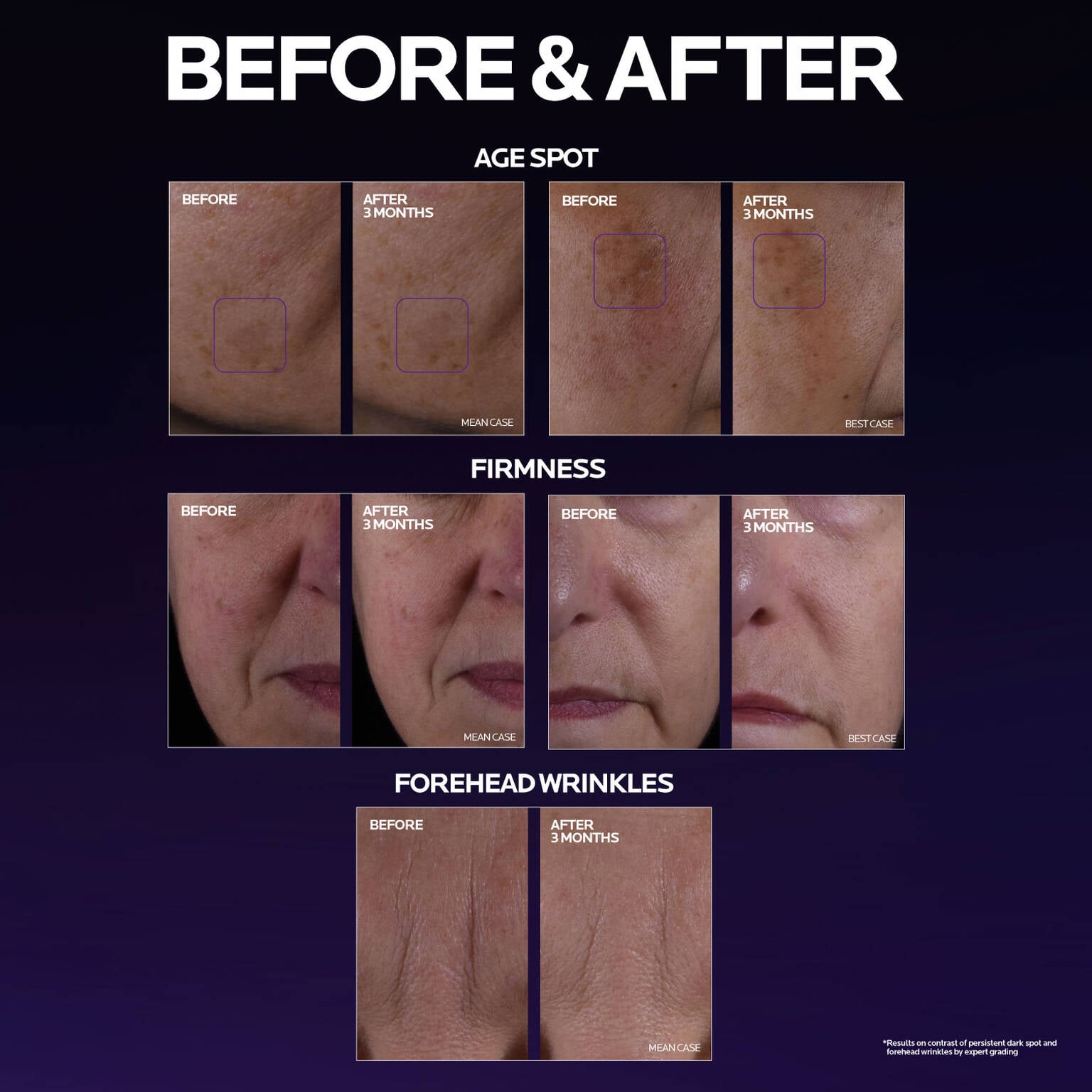 mela-b3-double-dose-discoloration-treatment-with-melasyltm-x2 MelaB3_DD_BTF_BeforeAfter_1500x1500_5.jpg